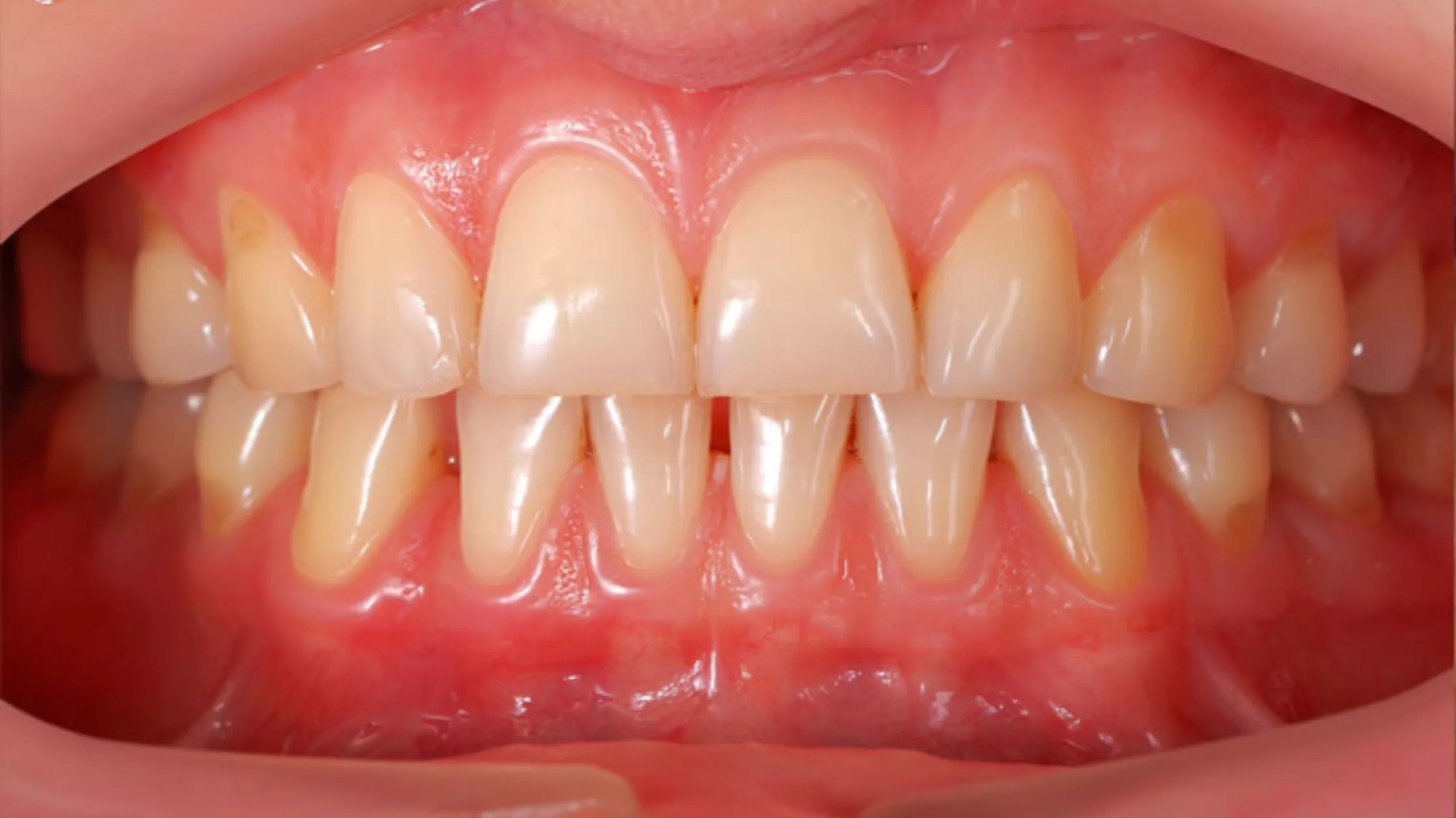 Is It Possible to Cure Gum Disease Without a Dentist?