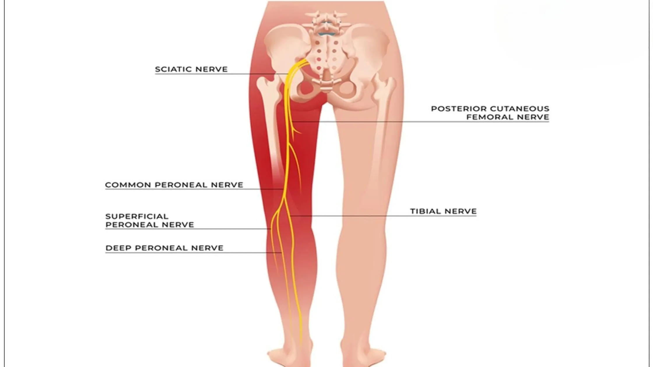 Beyond the Basics: Exploring Chronic Sciatica in its Last Stages