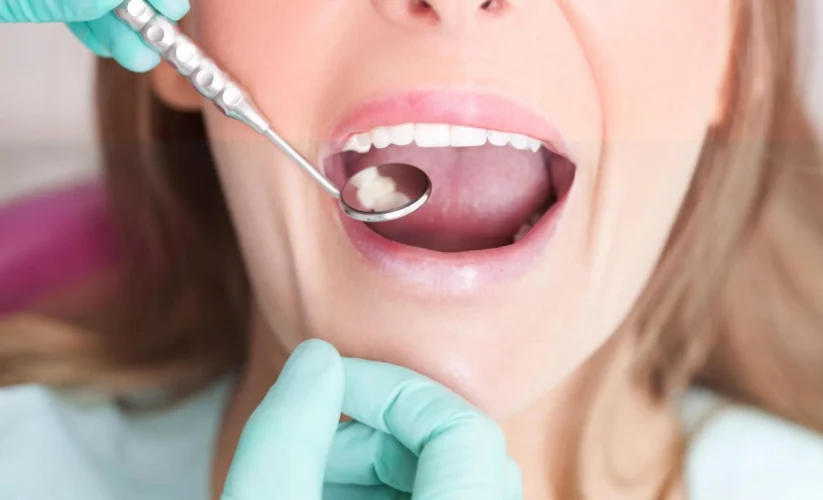 Cavity Between Teeth