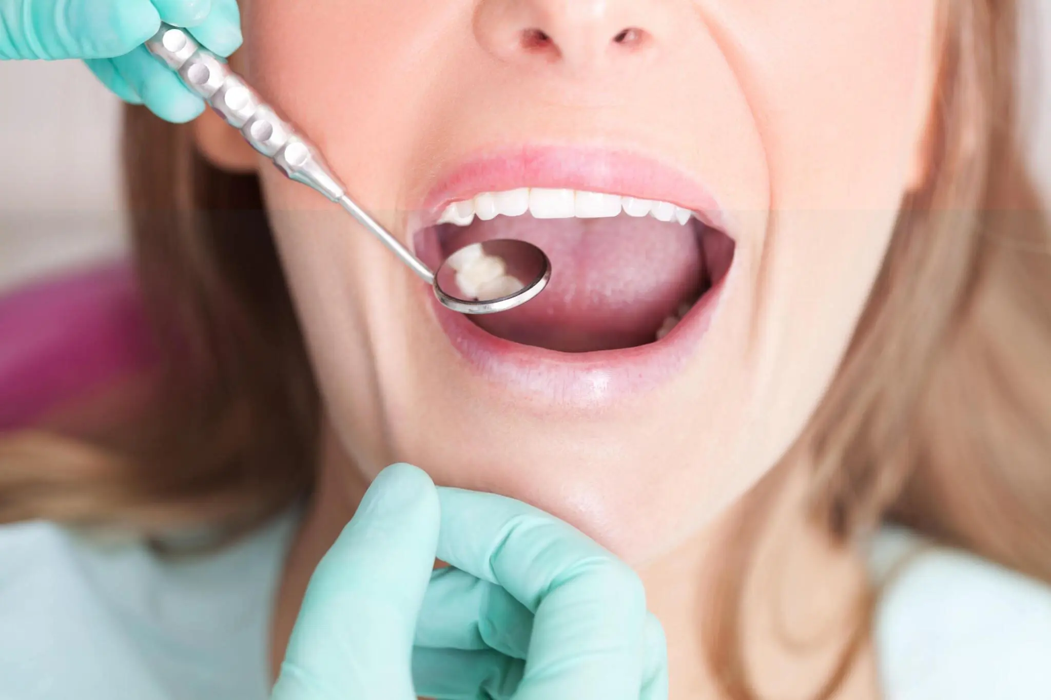 What is a Cavity Between Teeth?