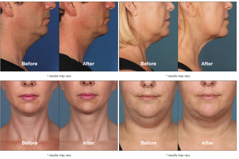Importance of Kybella Before and After Photos