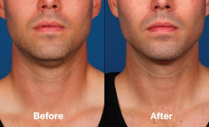 Kybella Before and After Transformations