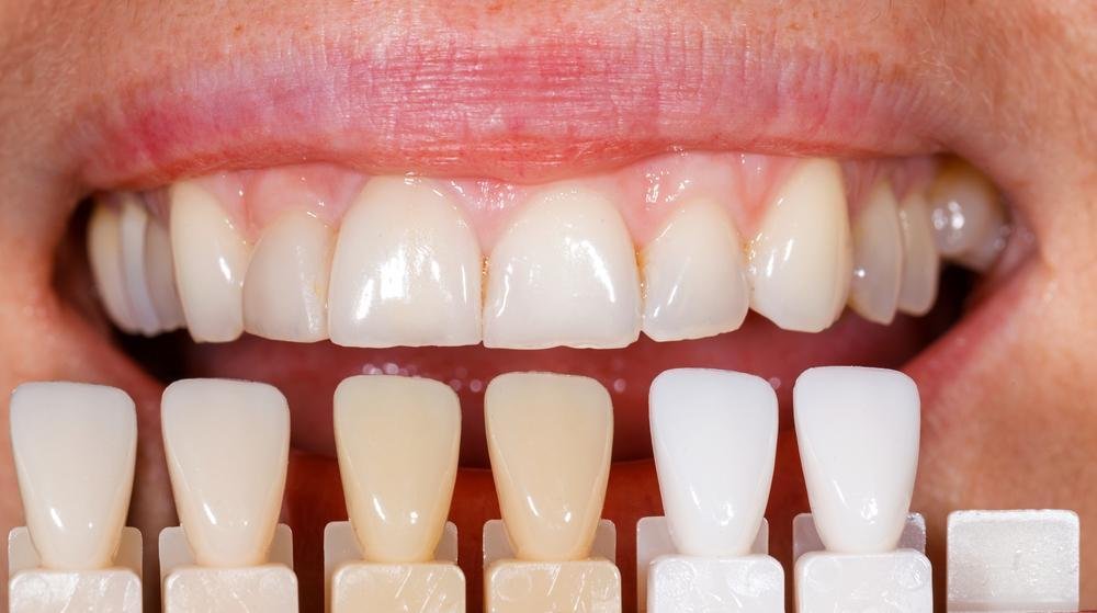Type of Teeth Prepping
