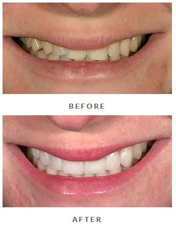 When to Get Teeth Prepped for Veneers