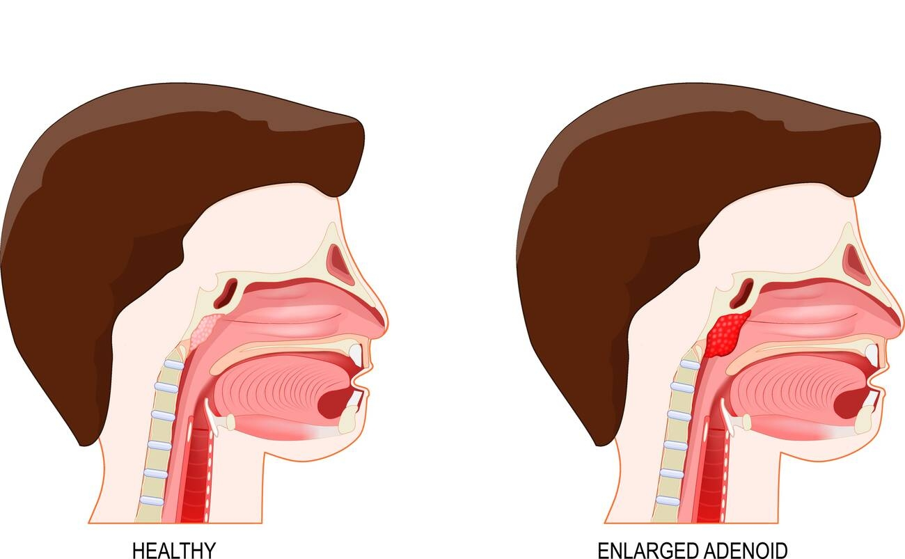 adenoid hypertrophy