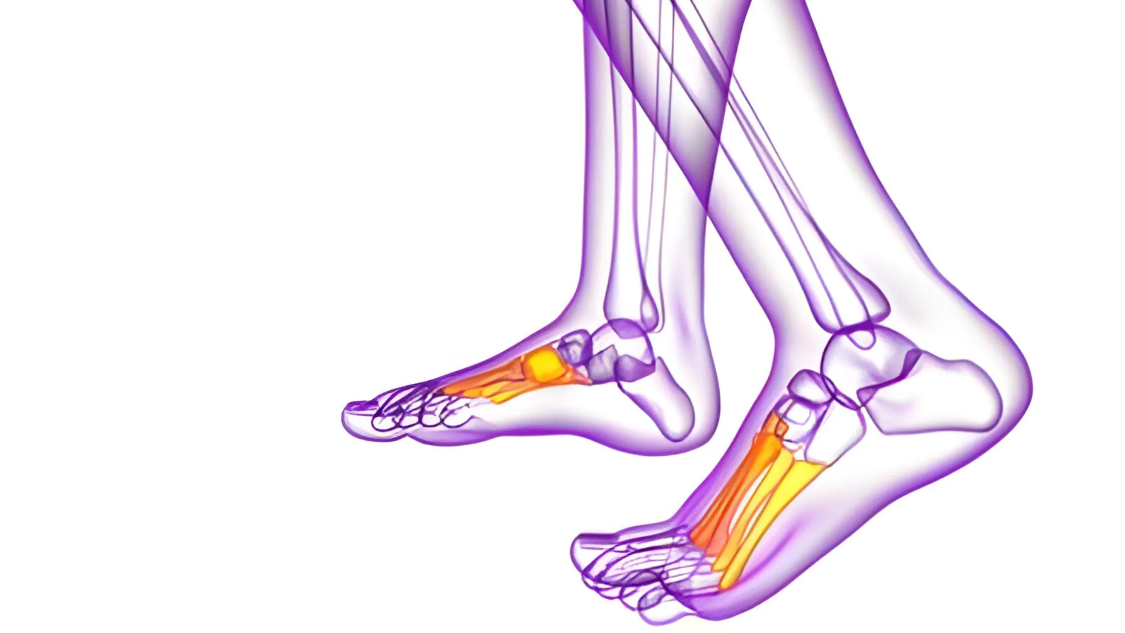 Understanding Midfoot Sprain: Causes, Symptoms, and Treatment