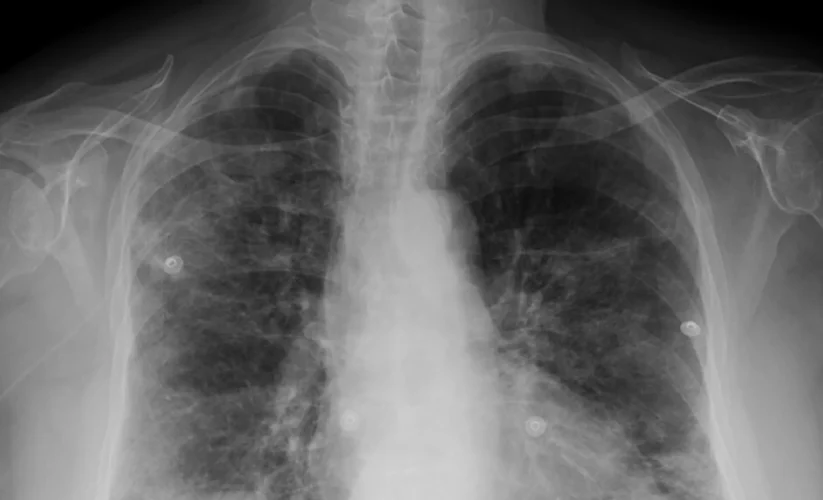 What is Multifocal Pneumonia?