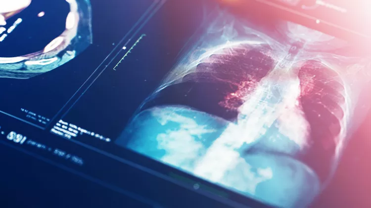 Diagnosis Of multifocal pneumonia