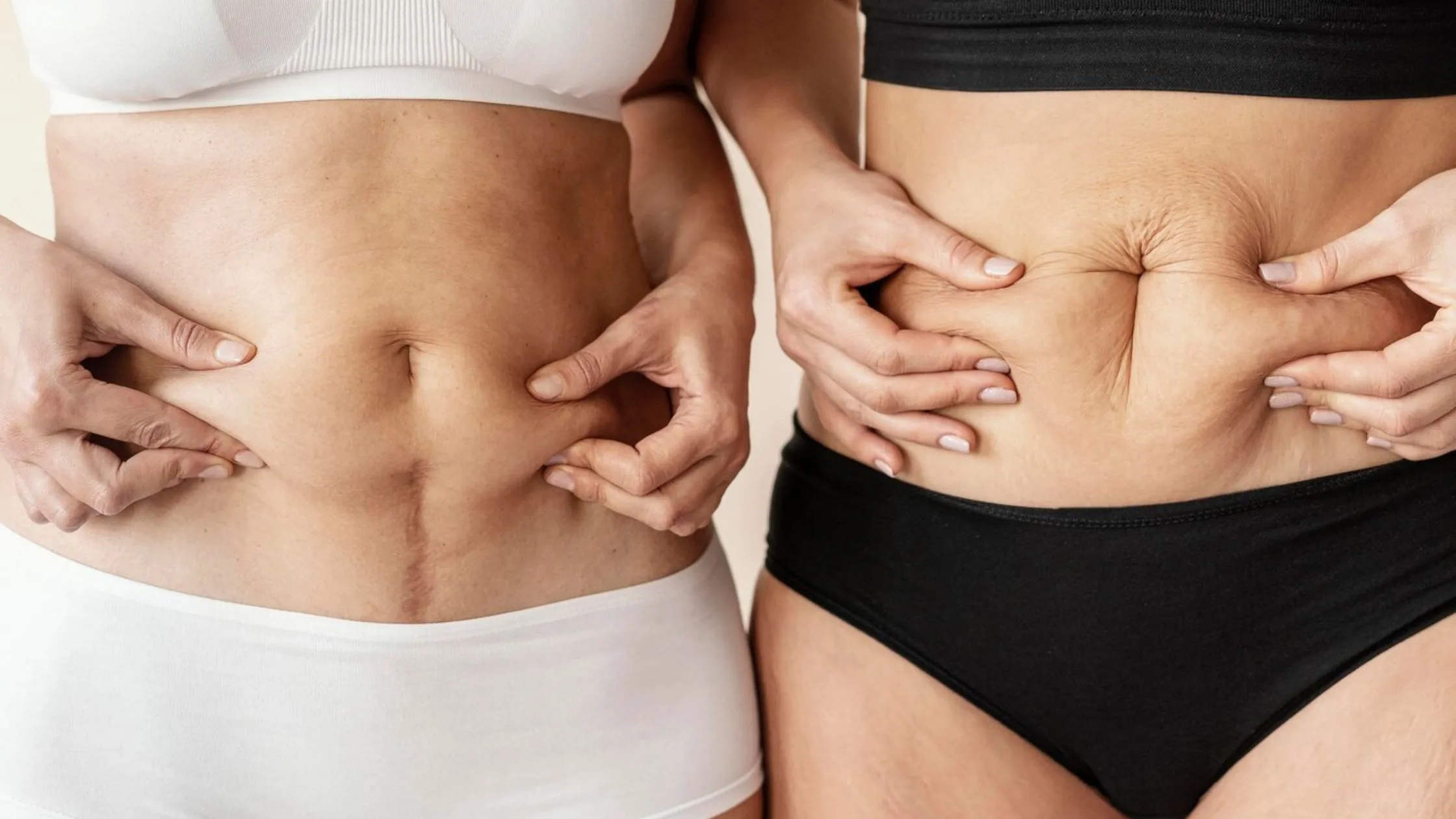 Tummy Tuck Before And After: Transformations Unveiled