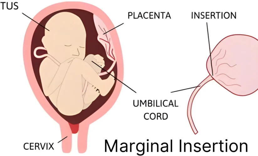 What is Marginal Cord Insertion?