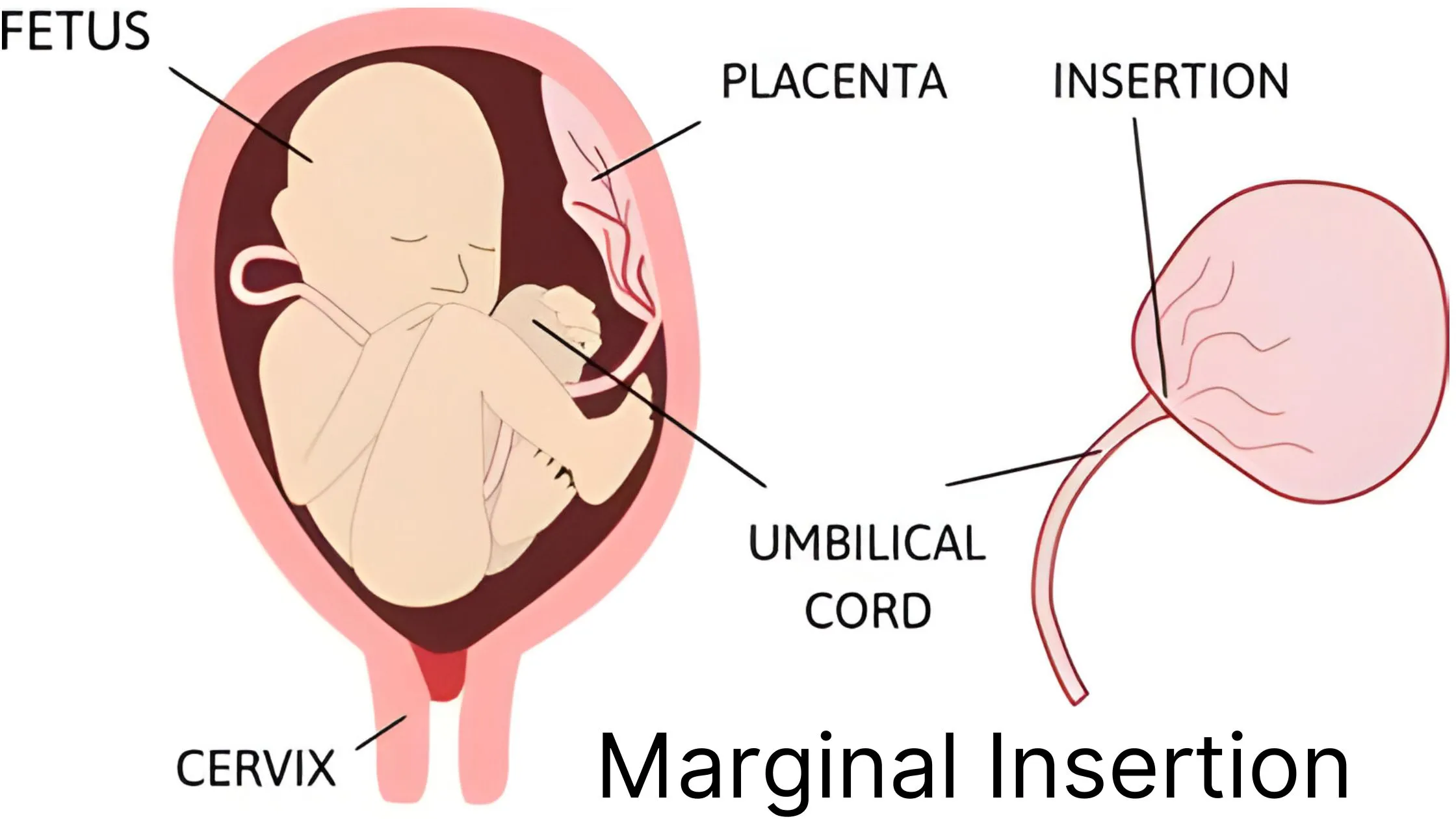 What is Marginal Cord Insertion?