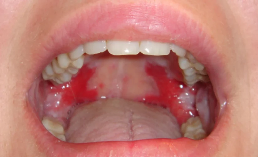 Red Spots On The Top Of Mouth