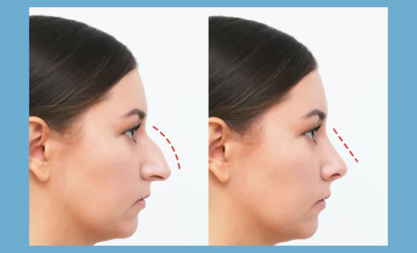 Rhinoplasty Before And After