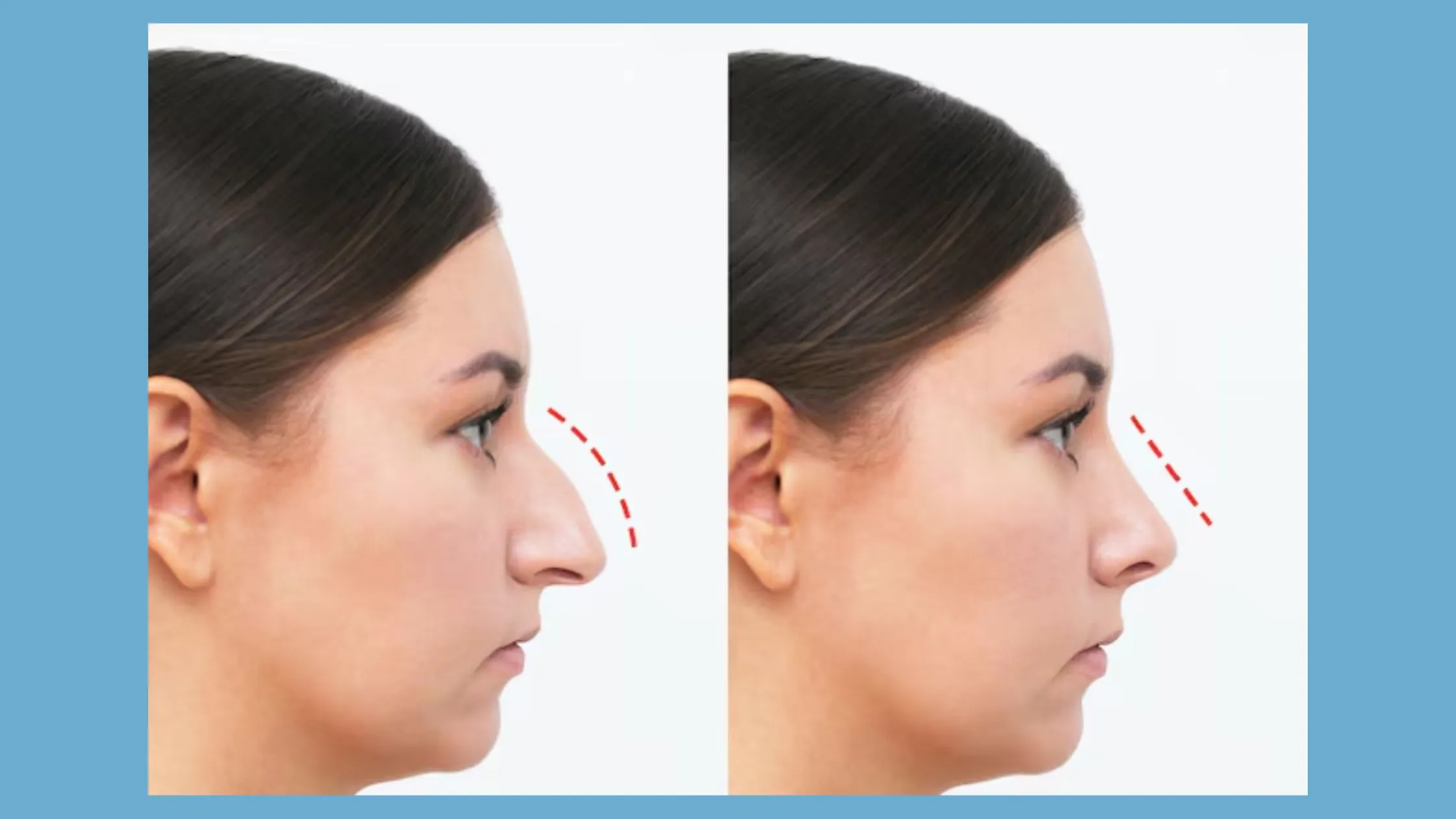 Dramatic Rhinoplasty Before and After Transformations